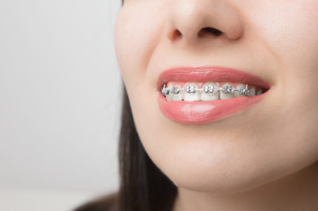 Young woman smile with dental braces. Brackets on the teeth after whitening. Self-ligating brackets