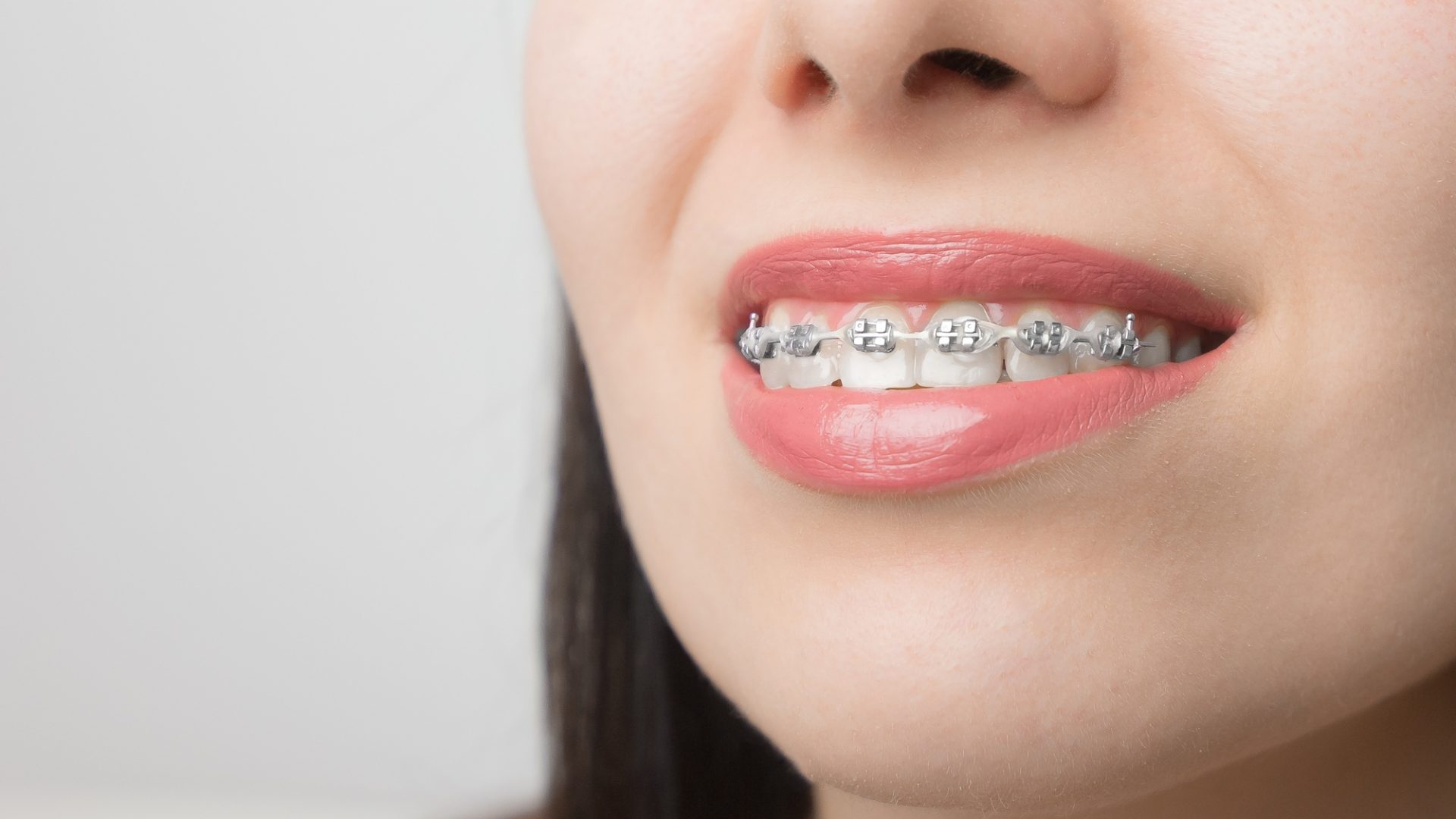Young woman smile with dental braces. Brackets on the teeth after whitening. Self-ligating brackets